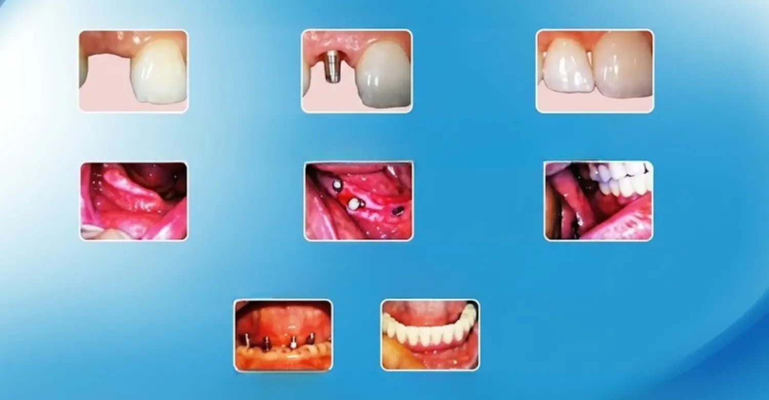 Denture Procedures 2